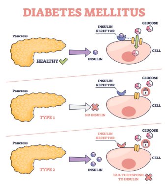 Diyabet yüksek kan şekeri ve metabolik hastalık diyagramı olarak mellitus