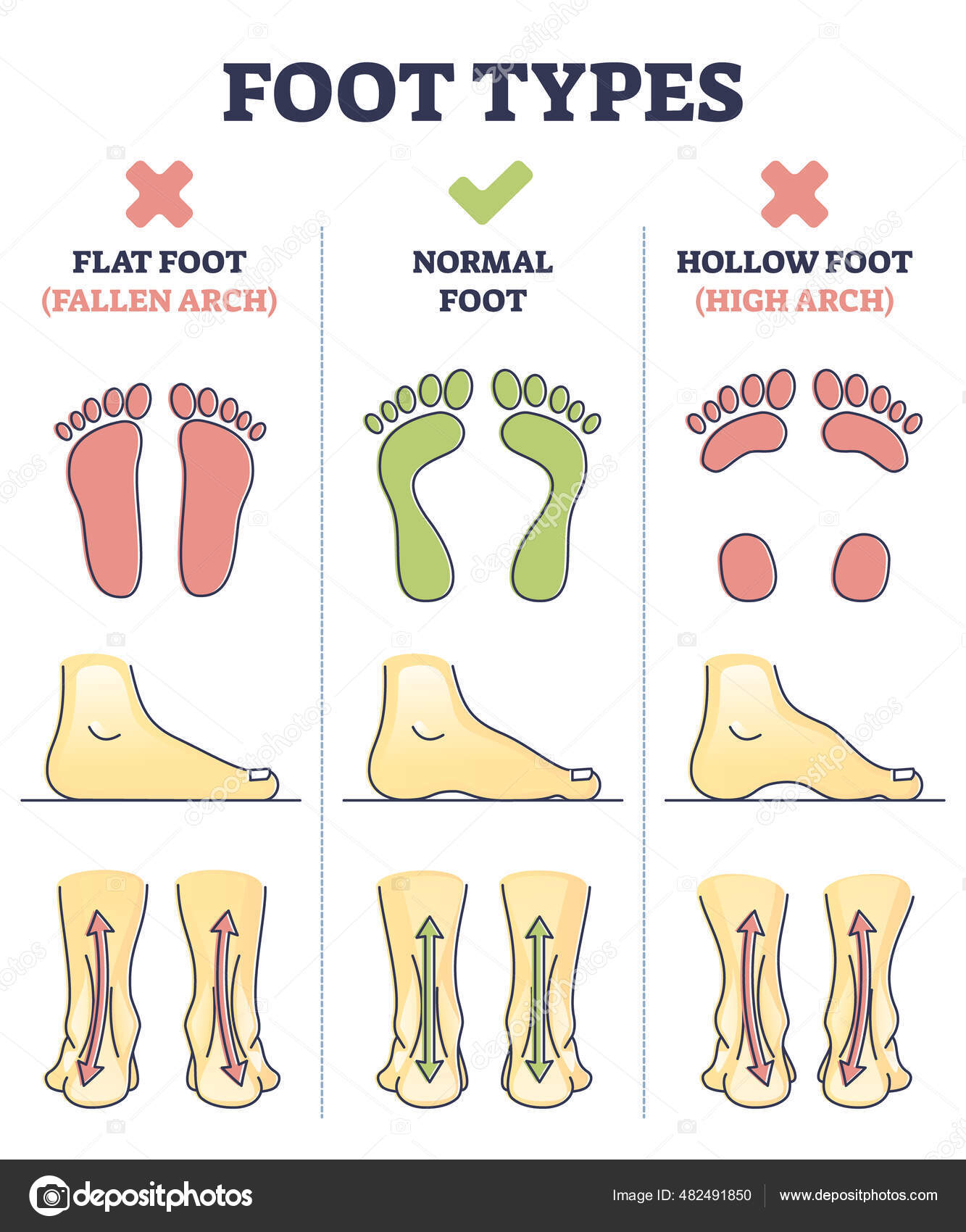 Foot Types With Flat, Normal And Hollow Feet Comparison In Outline.