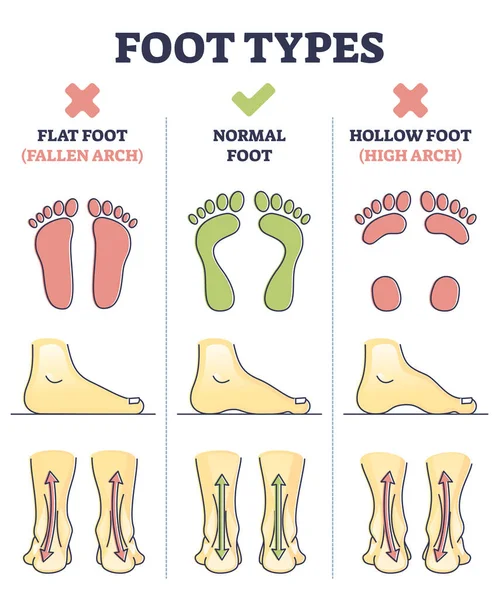 Foot types with flat, normal and hollow feet comparison in outline diagram — стоковый вектор