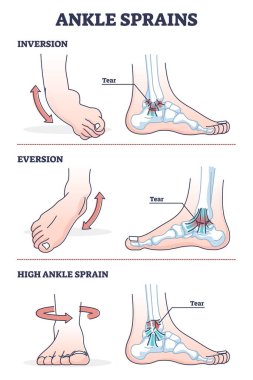 Ankle sprains situations with inversion and eversion injury outline diagram clipart