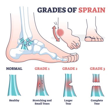 Grades of sprain as ankle or foot medical injury levels outline diagram clipart
