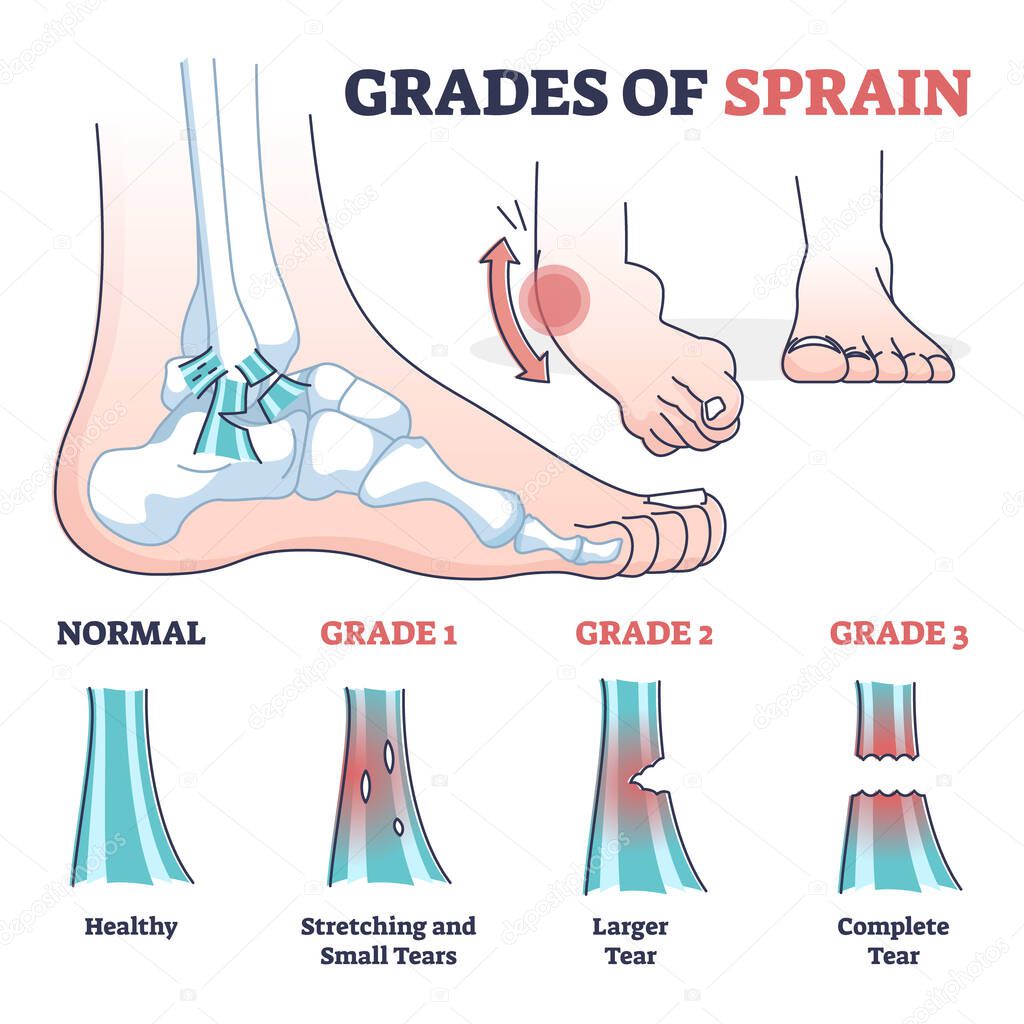 Grades of sprain as ankle or foot medical injury levels outline diagram