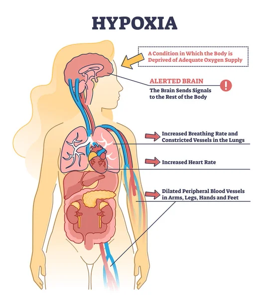 Hypoxia condition as lack of oxygen in brain cells or tissues outline diagram — Stock Vector