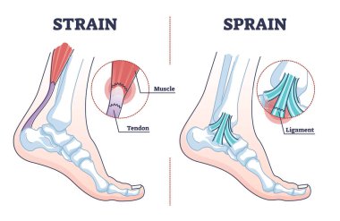 Burkulma ve anatomik karşılaştırma tıbbi ayak yaralanması diyagramı gibi