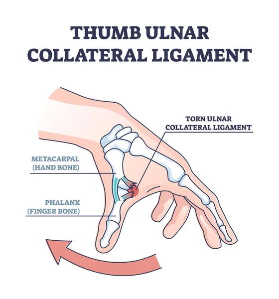 Ligamento colateral ulnar do polegar como lesão do dedo e diagrama de contorno do problema — Vetor de Stock