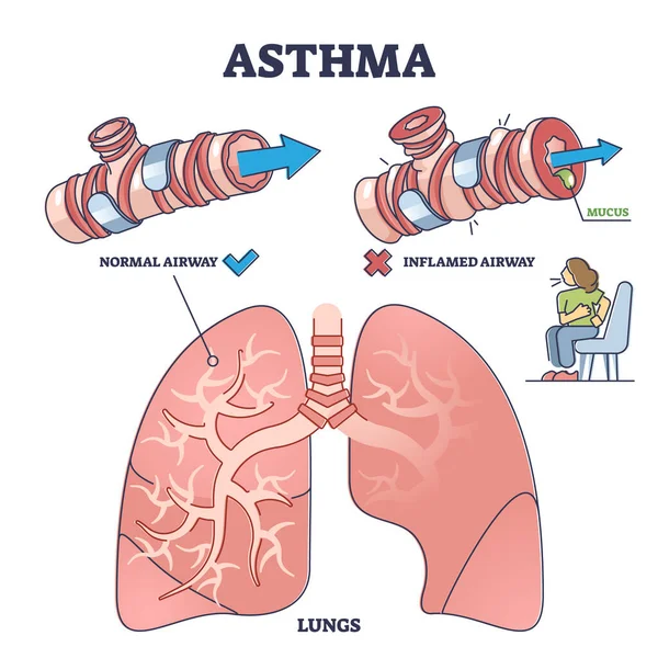 Condición de salud del asma comparada con el diagrama normal e inflamado del contorno de las vías respiratorias — Vector de stock