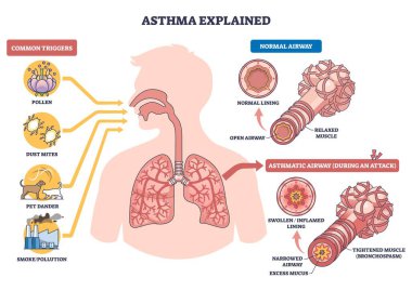 Astım, akciğerlerin, bronşların ve tetikleyicilerin olduğunu, astım iltihabı, mukus ve kasların nefes darlığına yol açtığını gösteriyor. Özet diyagramı