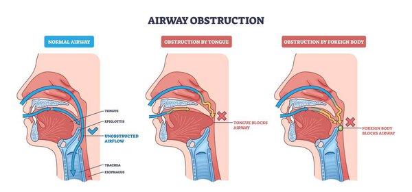 Airway obstruction diagram shows normal airflow vs blockage by tongue or foreign body, key parts, tongue, epiglottis, trachea. Outline diagram
