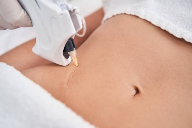 Yara izini silmek için güzellik kliniğine gelen kadın.