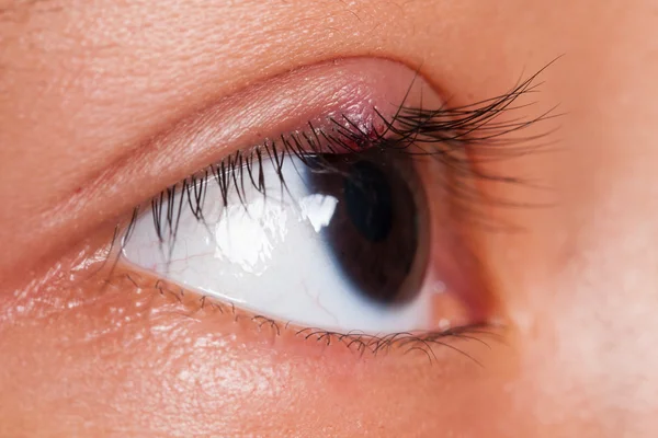 Close-up van rechter boven oog deksel abces, stye of hordeolum — Stockfoto