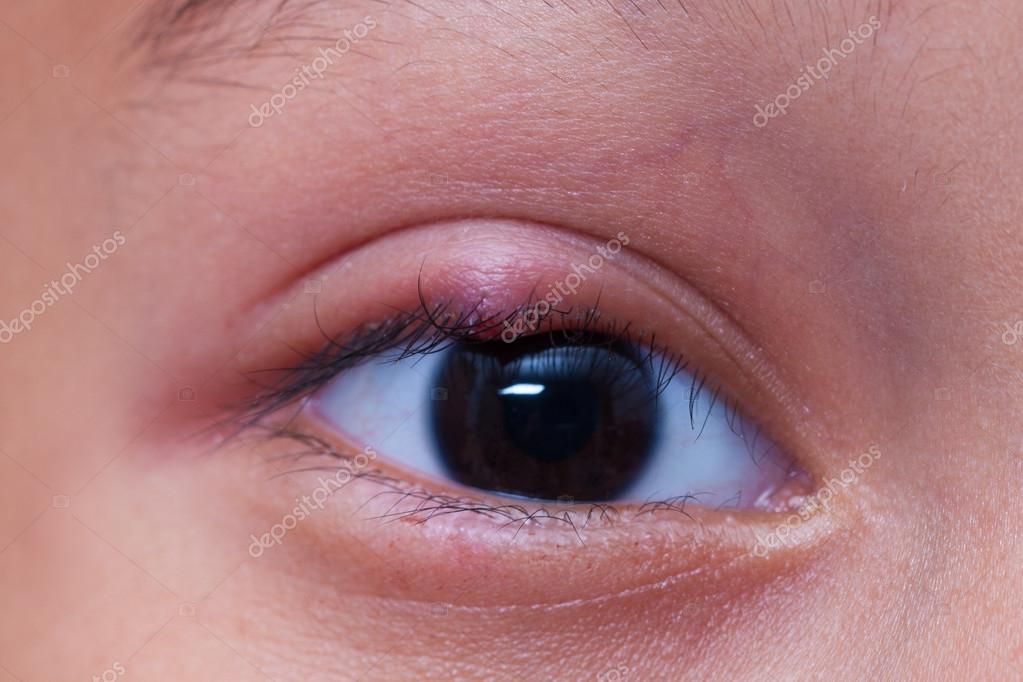 Close up right upper eye lid abscess, stye or hordeolum — Stock Photo