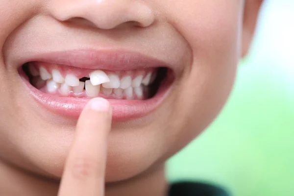 Kleiner Junge mit kaputten Zähnen und faulen Zähnen — Stockfoto