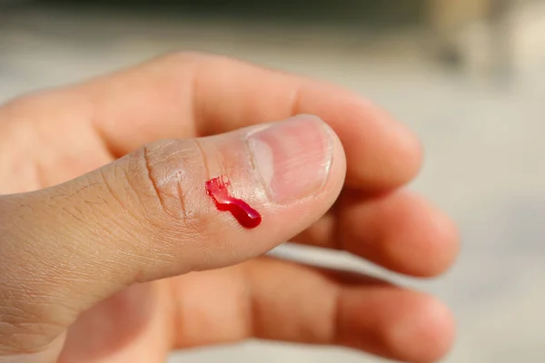 Кровотечение Травмы Большого Пальца — стоковое фото