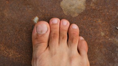 Male Foot with second toe longer than a big toe. Mortons's toe, Greek foot or Royal toe or Aboriginal feet. clipart