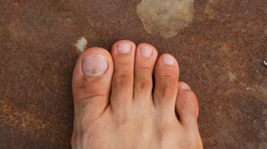 Male Foot with second toe longer than a big toe. Mortons's toe, Greek foot or Royal toe or Aboriginal feet. clipart