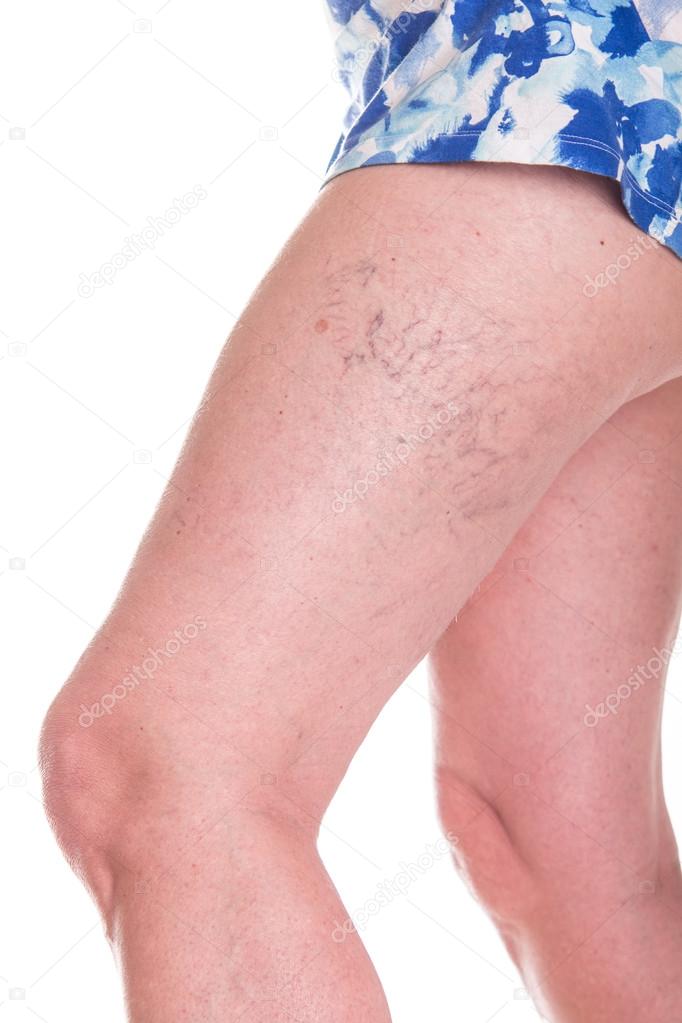 Human spaider veins on the legs of woman