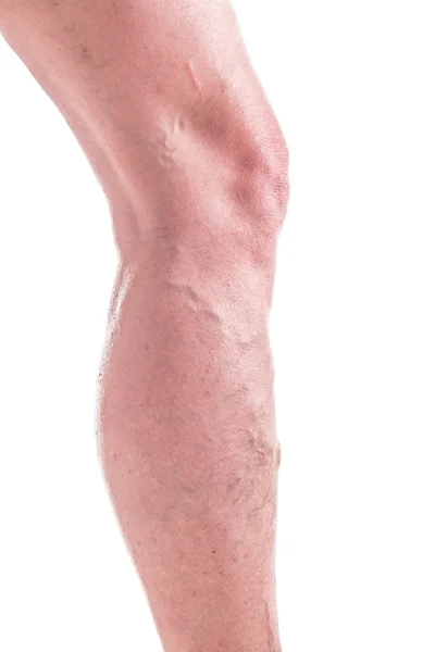 Venas varicosas en las piernas de la mujer — Foto de Stock
