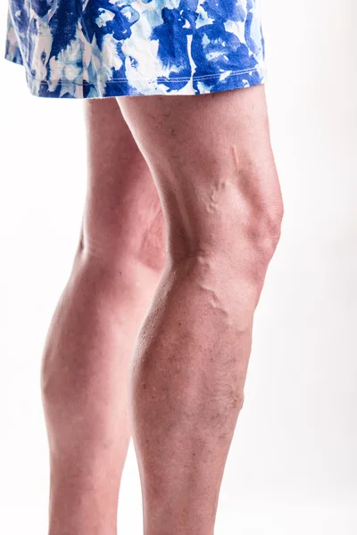 Kadın bacaklarda varis