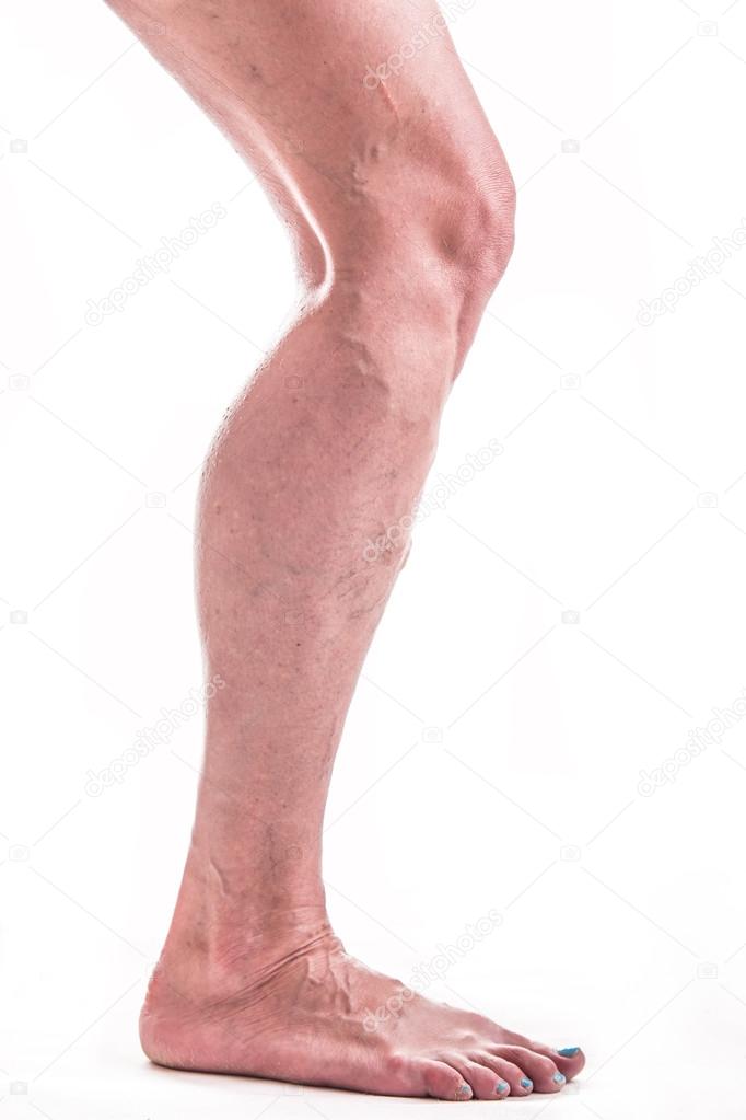 Varicose Veins on the legs of woman