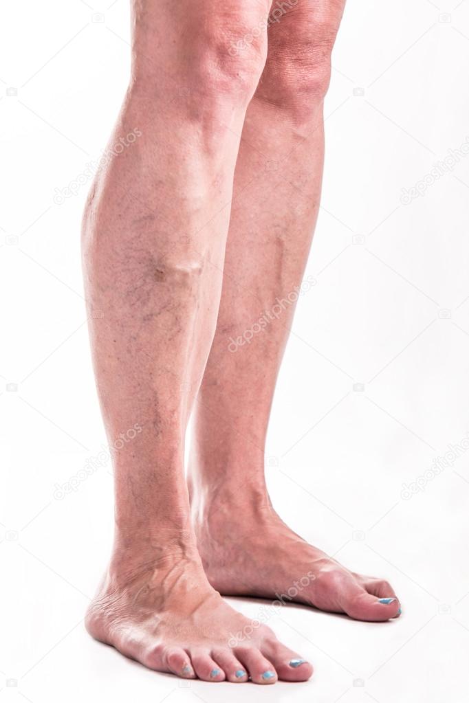 Varicose Veins on the legs of woman