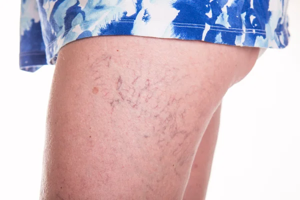 Varicose Veins on the legsv — Stock Photo, Image