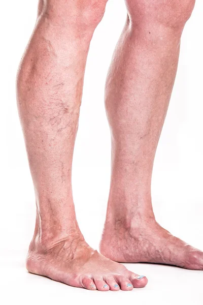 Varicose Veins on the legsv — Stock Photo, Image