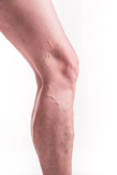 Varicose Veins on the legsv — Stock Photo, Image