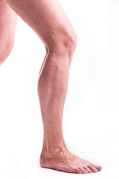 Varicose Veins on the legsv — Stock Photo, Image