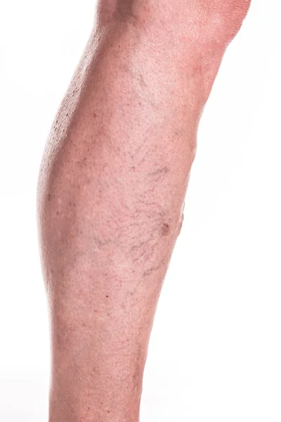 Veias varicosas em pernas de mulher — Fotografia de Stock