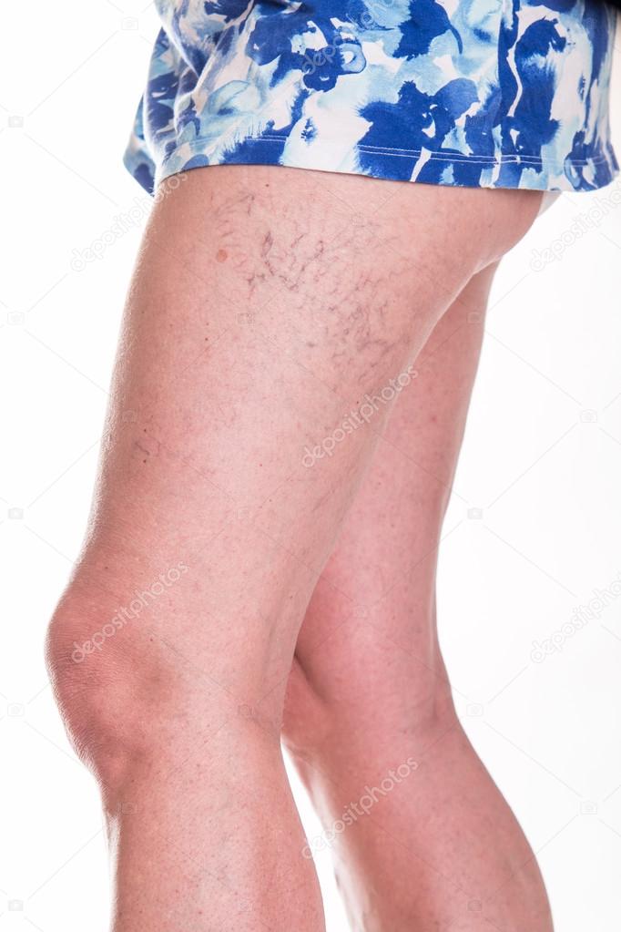 Human spaider veins on the legs of woman