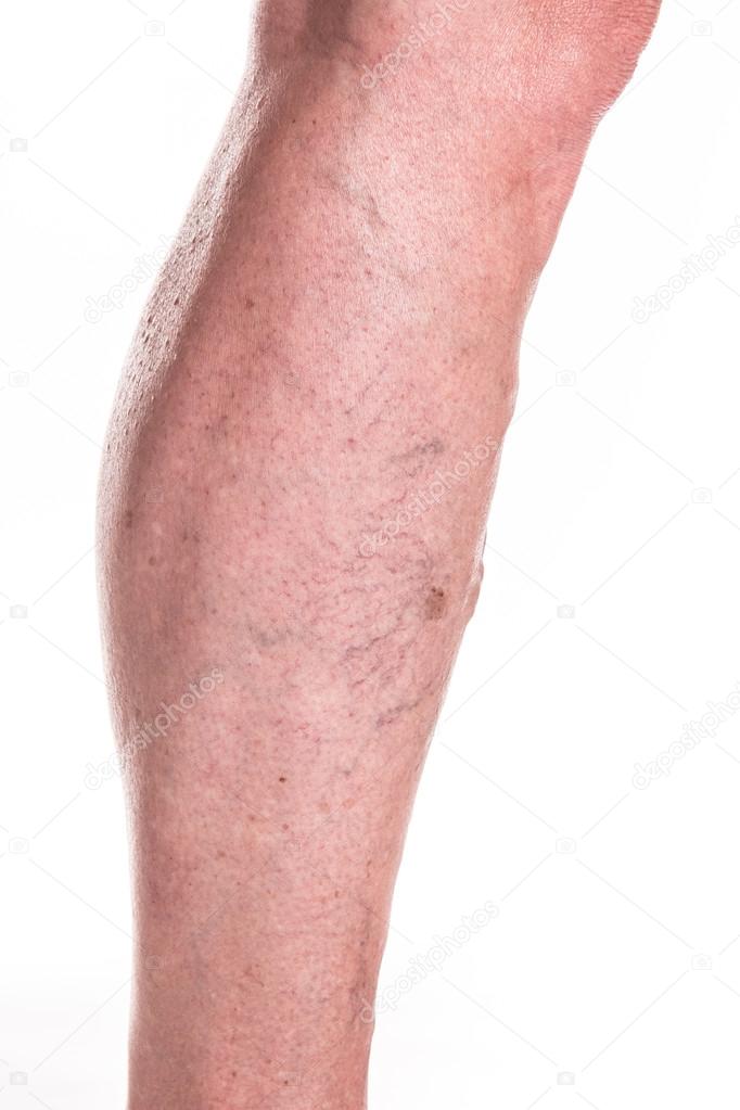 Varicose Veins on legs of woman