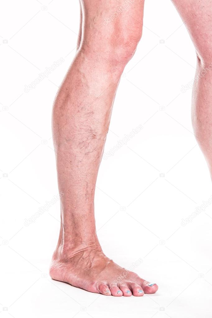 Varicose Veins on legs of woman