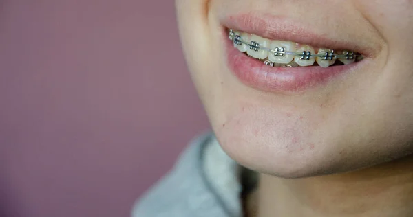 Hermosa Chica Joven Caucásica Frenos Dentales Sonrisas Concepto Adolescente Alineación — Foto de Stock