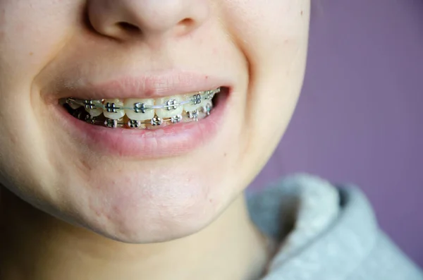 Hermosa Chica Joven Caucásica Frenos Dentales Sonrisas Concepto Adolescente Diseño Fotos De Stock