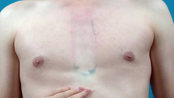 Evde Balmumu Epilasyon Kullanan Kıllı Bir Adamın Göğsünü Kapatın Vücut — Stok fotoğraf