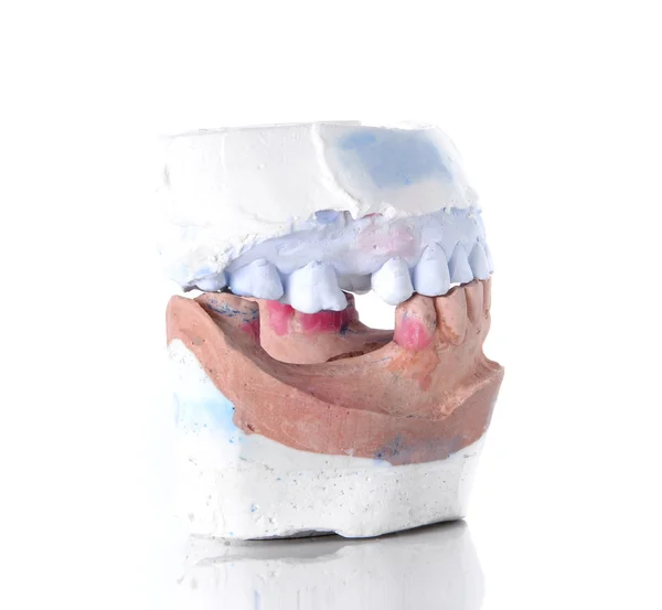 Форма протеза, сломанный зуб на белом фоне . — стоковое фото