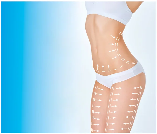 The cellulite removal plan. White markings on young woman body — Stock Photo, Image