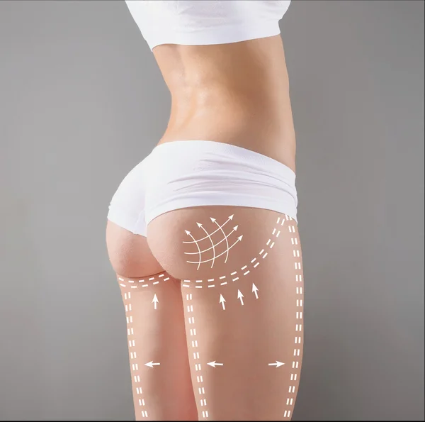 Markierungen am Gesäß, an der Taille und an den Beinen der Frau vor einer Schönheitsoperation. — Stockfoto