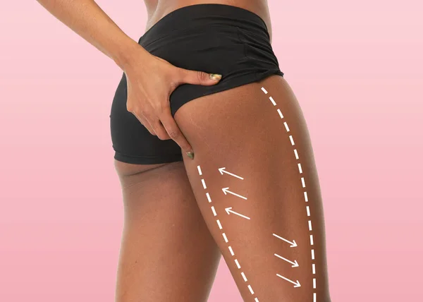 Marcas en las nalgas, cintura y piernas de las mujeres antes de la cirugía plástica. —  Fotos de Stock