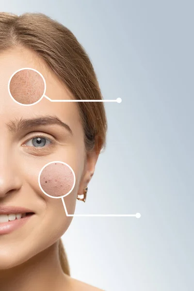 Problemas con el acné en la piel femenina. Retrato recortado de mujer joven — Foto de Stock