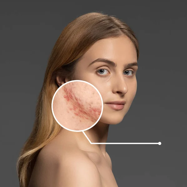 Problémy s akné na ženské pleti obličeje. Portrét mladé dívky — Stock fotografie