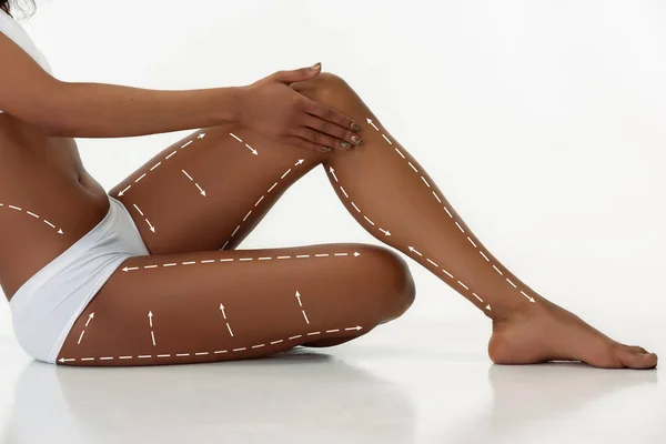 Marcas en las caderas, cintura y piernas de las mujeres antes de la cirugía plástica. Caucásico joven en forma mujer como modelo —  Fotos de Stock
