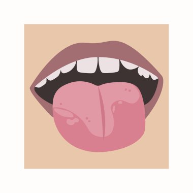 Dilinde beyaz lekeler var. Dermatologlar ya da dişçiler için hastalığı olan bir çocuğun ağzının vektör çizimi.