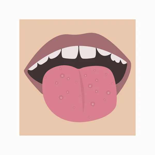 Грибок або прищі на язиці. Вектор рота дитини з хворобою . — стоковий вектор