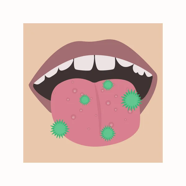 Hongos o acné en la lengua. Vector de un niño boca con una enfermedad — Vector de stock