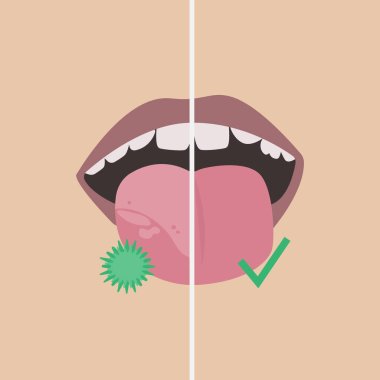 Comparison. White spots on the tongue with bacteria and a healthy tongue. clipart