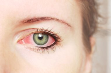 Closeup of irritated red bloodshot eye - conjunctivitis clipart