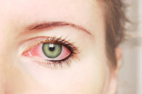Acercamiento del ojo rojo irritado inyectado en sangre - conjuntivitis — Foto de Stock