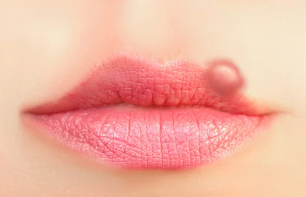 Primer plano de un herpes labial común . — Foto de Stock