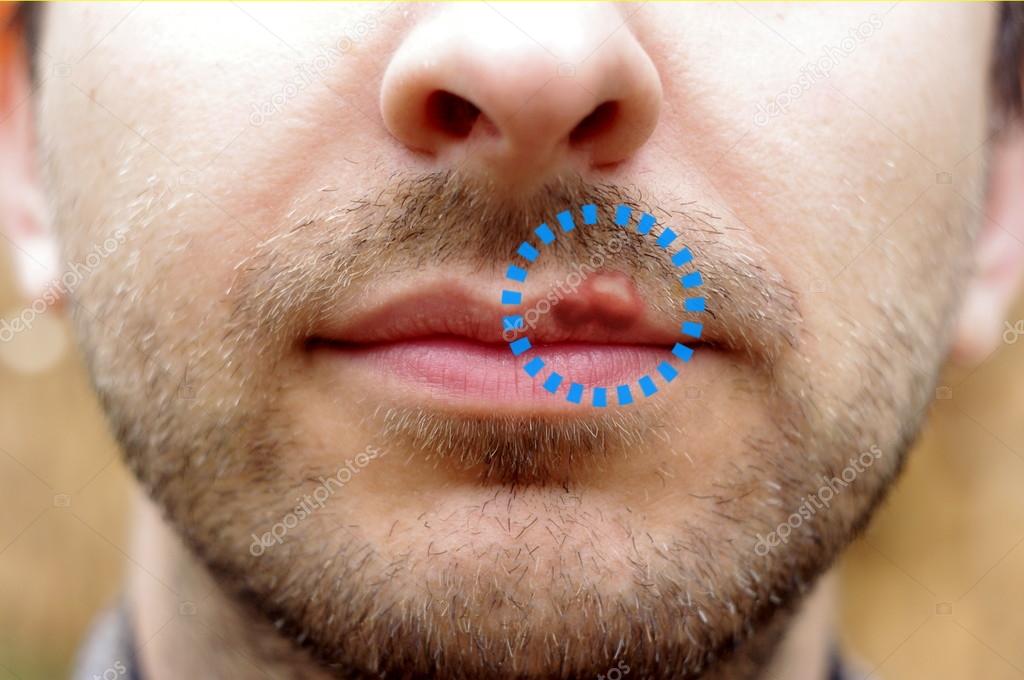 Dating a guy with cold sores
